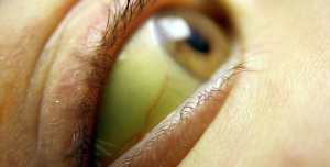 Нова стратегия при лечение на хроничен хепатит В  