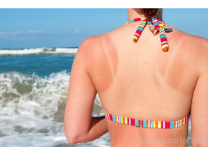 Защо изгаряме от слънцето