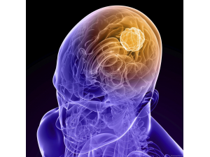 Нов пробив в борбата с рака на мозъка
