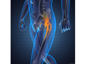 Извършиха уникална операция на тазобедрена става