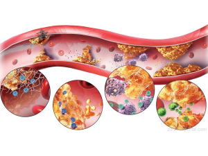Нова теория за произхода на атеросклерозата
