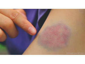 Защо получаваме синини по тялото?