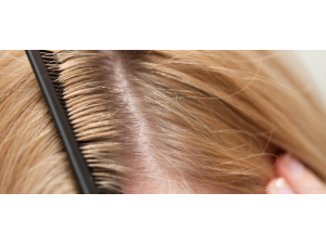 Пърхот – какво най-често го причинява?