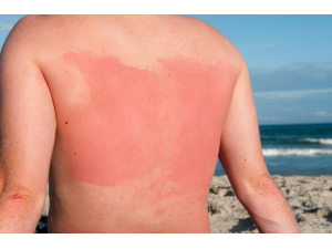 Как да предпазим кожата от слънчево изгаряне?