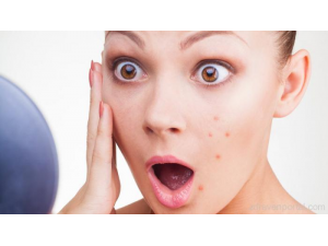 8 начина за борба с акнето чрез натурални средства