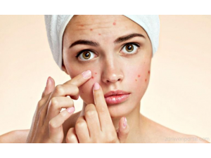 Акне – какво включва терапията ?