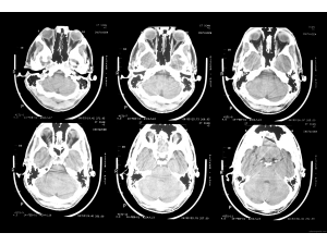 Китайци са извършили първата в историята трансплантация на глава