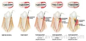 624-300-zyb-zybolekar-parodontit